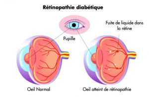 Rétinopathie diabétique - Centre vision laser maroc